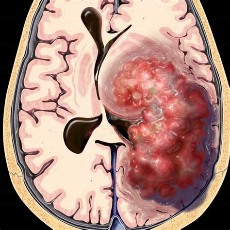 Tumor Cerebral Aprenda A Identificar Os Sintomas Da Doen A Segredos