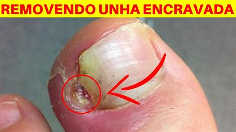 Tirei O Canto Da Unha E Inflamou O Que Fazer