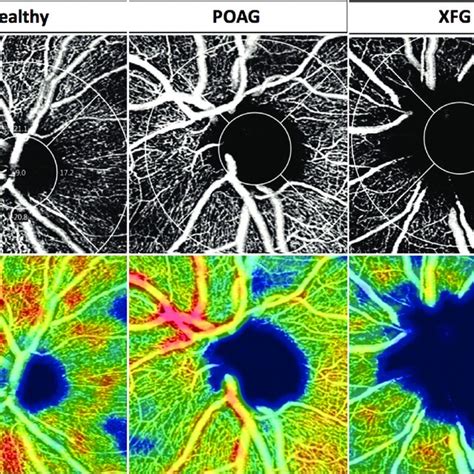 Fovea Avascular Zone Parameters Download Scientific Diagram