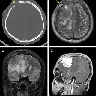 Dural-based lesions: is it a meningioma? | Request PDF