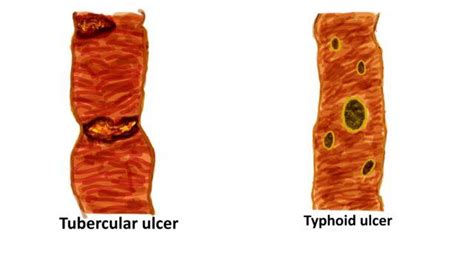 Tubercular Vs Typhoid Ulcer Pathology Made Simple