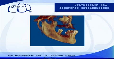 Pptx Osificacion Del Ligamento Estilohioideo Pdfslide Net