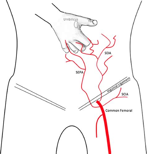 Pedicled Abdominal Flaps For Enhanced Digital Salvage After Severe Frostbite Injury Wilderness