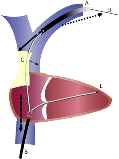 Successful Avoidance Of Superior Vena Cava Injury During Transvenous