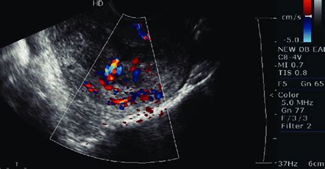 Abnormal Transvaginal Ultrasound