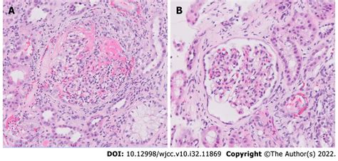 Light Microscopy Findings A Many Glomeruli Had Active Global Cellular