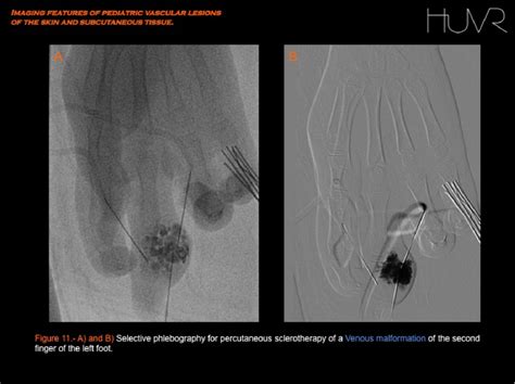 Figure 7 From Imaging Features Of Pediatric Vascular Malformations Of The Skin And Subcutaneous