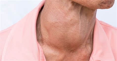 Hashimotos Thyroiditis Is A Condition In Which Immune System