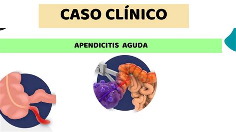 Caso Cl Nico Apendicitis Aguda Lupita Udocz