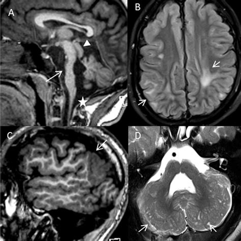 Pdf Fukuyama Congenital Muscular Dystrophy