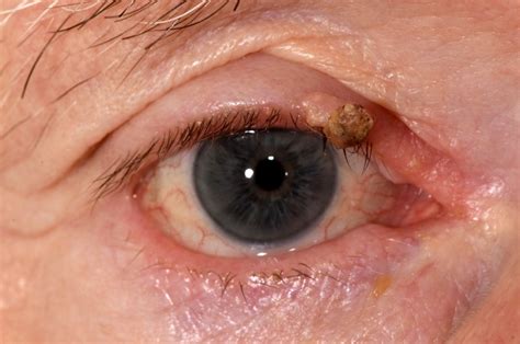 Cutaneous Horn Eyelid