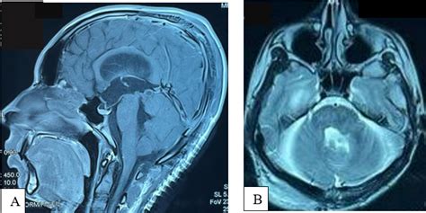 A Follow Up Magnetic Resonance Imaging Demonstrated Complete