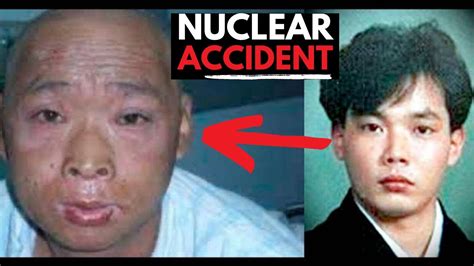 Kept Alive For 83 Days Against His Will Hisashi Ouchi S Nuclear