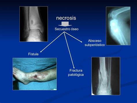 Tratamiento Osteomielitis Us