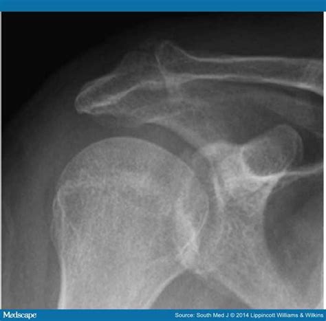 What Is Acromioclavicular Osteoarthritis