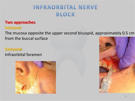 Ppt Trigeminal Nerve Powerpoint Presentation Free Download Id2586490