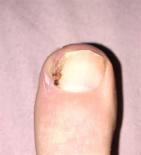 Can my toe still be infected after being on antibiotics for a week and