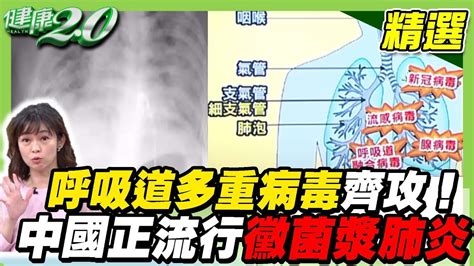 流感、呼吸道多重病毒齊攻！ 中國正流行黴漿菌肺炎 台大醫警告：台灣恐大爆發 流感突胸痛、喘 當心大白廢釀壞死性肺炎！ 【健康2 0精選】 Youtube