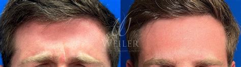 Botox Cosmetic Before And After Pictures Case Baton Rouge New