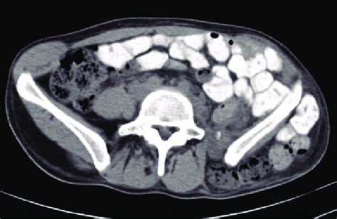 Axial Computed Tomography Scan Where Lateral Incisional Is Shown