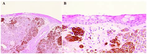 Histological findings of the lacrimal caruncle prior to topical ...