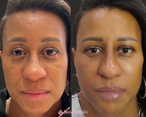 Cheek Fillers Before After Results At Skinly