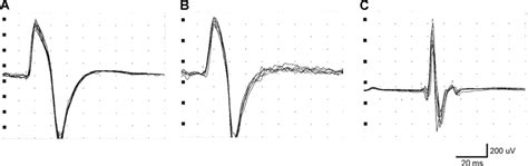 Normal recordings of biceps brachii T-reflex (a case 3; b case 5) and... | Download Scientific ...