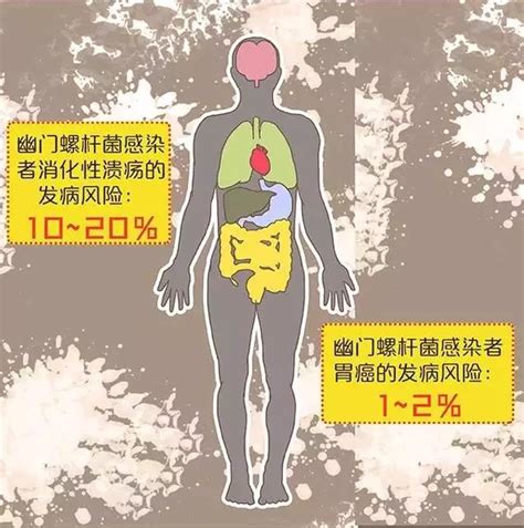 你也许在胃癌的队伍中感染幽门螺杆菌的危害有多大 知乎