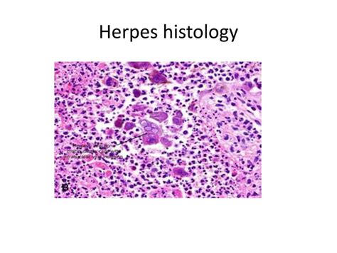 Herpetic Stomatitis Histology