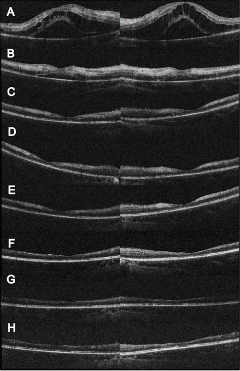 Serial changes in OCT. (A) Initial OCT showed profound macular edema ...