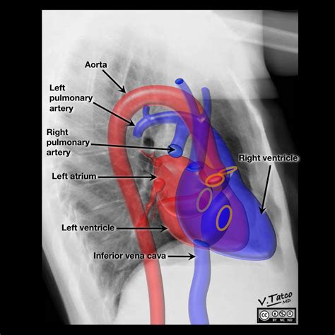 Heart Anatomy On Chest X Ray at Jose Boyd blog