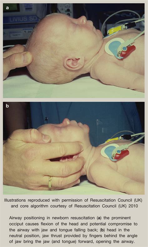 Resuscitation Of The Newborn Anaesthesia Intensive Care Medicine