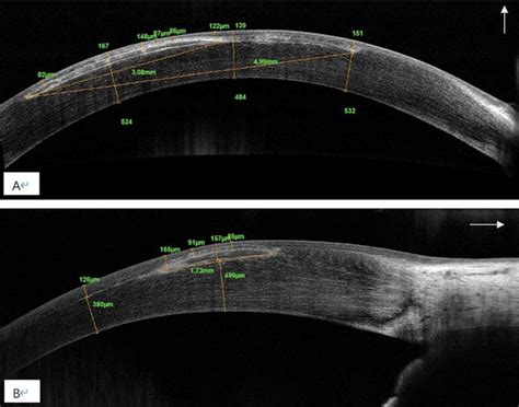 At 15 Months After Flap Lift Oct Image Vertically A And