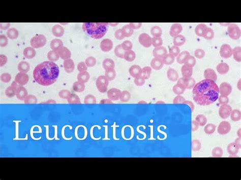 Leucocituria O Que É - Leucocituria: Significado y Relevancia en el Diccionario Médico
