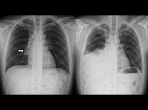 The Surgical Treatment of Hemothorax Which Videothoracoscopic ...