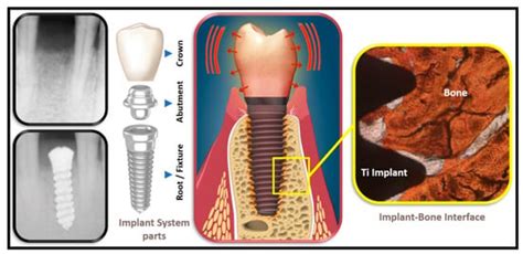 Dentistry Journal Free Full Text Thermal Load And Heat Transfer In Dental Titanium Implants