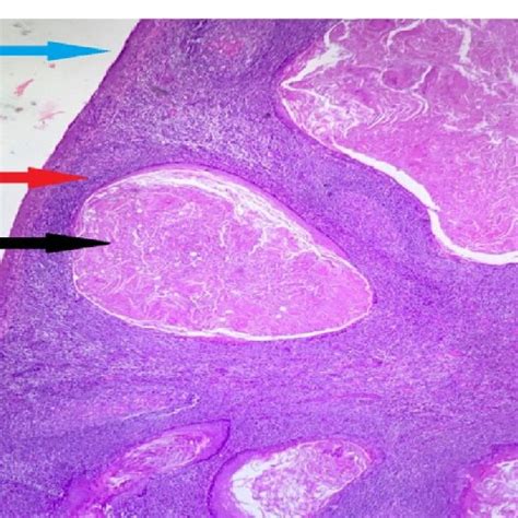 Tonsillar Epidermoid Cyst On Hpe Black Arrow Dilated Cysts Filled With