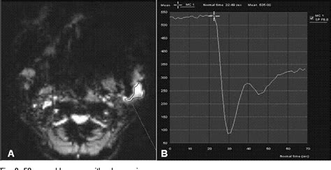 Figure 2 From Comparative Study Of Dynamic Susceptibility Contrast