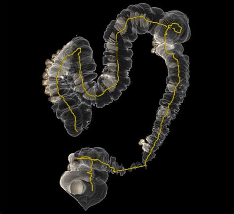 CT Colonography