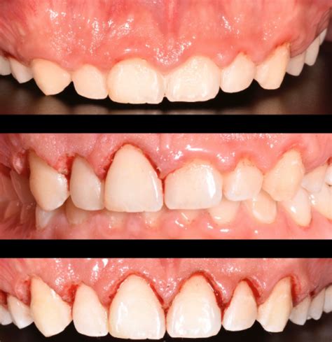 Gingivectomia Y Gingivoplastia Odontolaser