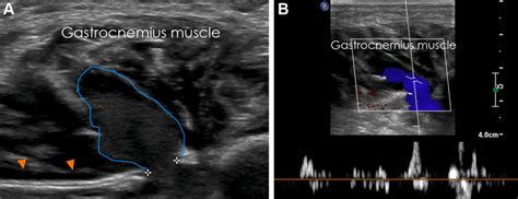 Gastrocnemius Vein Ultrasound