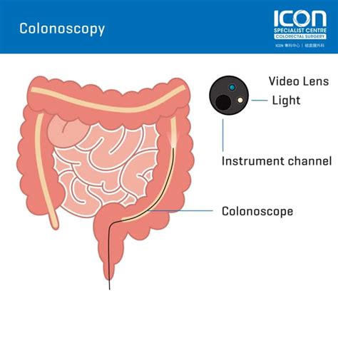 Colonoscopy — Icon Specialist Centre