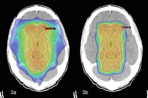 The Role Of Whole Brain Radiation Therapy For Metastatic Brain Tumors