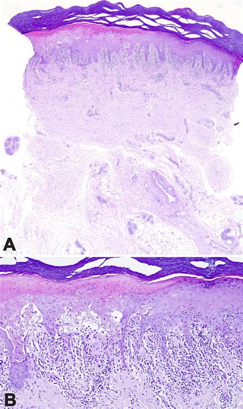 A Skin Punch Biopsy Form The Hand Showing Lichenoid Infiltrate Rich