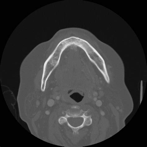 Mandibular Osteomyelitis Radiologypics