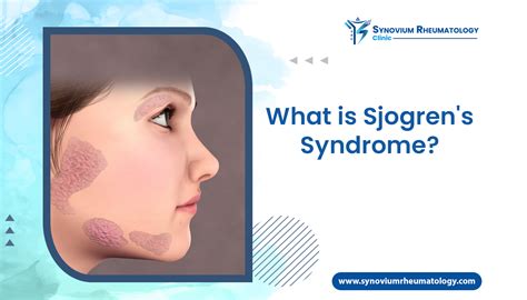 What Is Sjogrens Syndrome Symptoms Causes Synovium