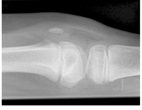 Lateral X Ray Of The Right Knee Demonstrating A Hypoplastic Patella