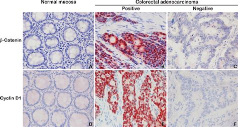 Immunohistochemical Staining For β Catenin A C And Cyclin D1 D Download Scientific