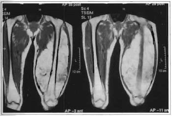 RBCP Giant Lipoma Of The Thigh Case Report