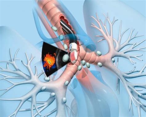 Endobronchial Ultrasound Ebus Dr Agrawal